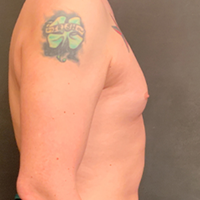 Mtf Breast Augmentation 09