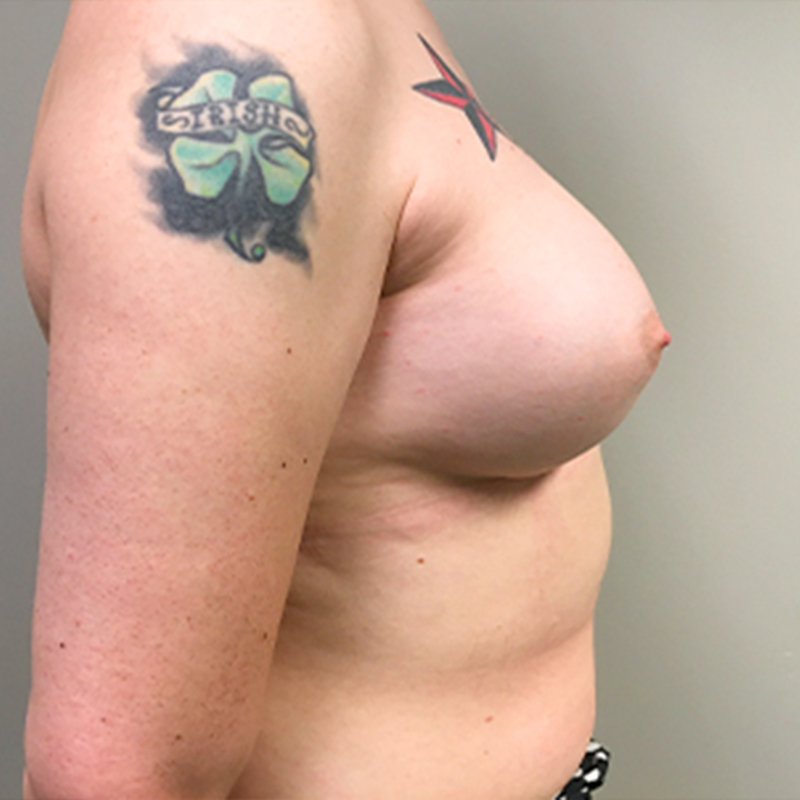 Mtf Breast Augmentation 09