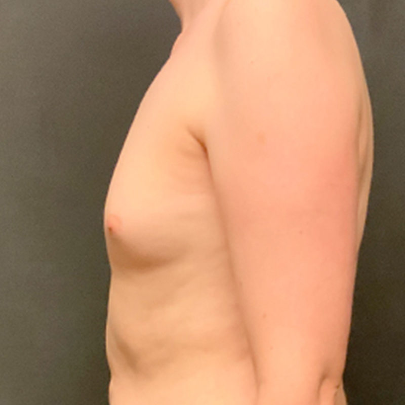 Mtf Breast Augmentation 03