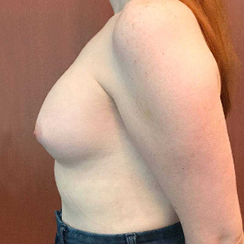 Mtf Breast Augmentation 03