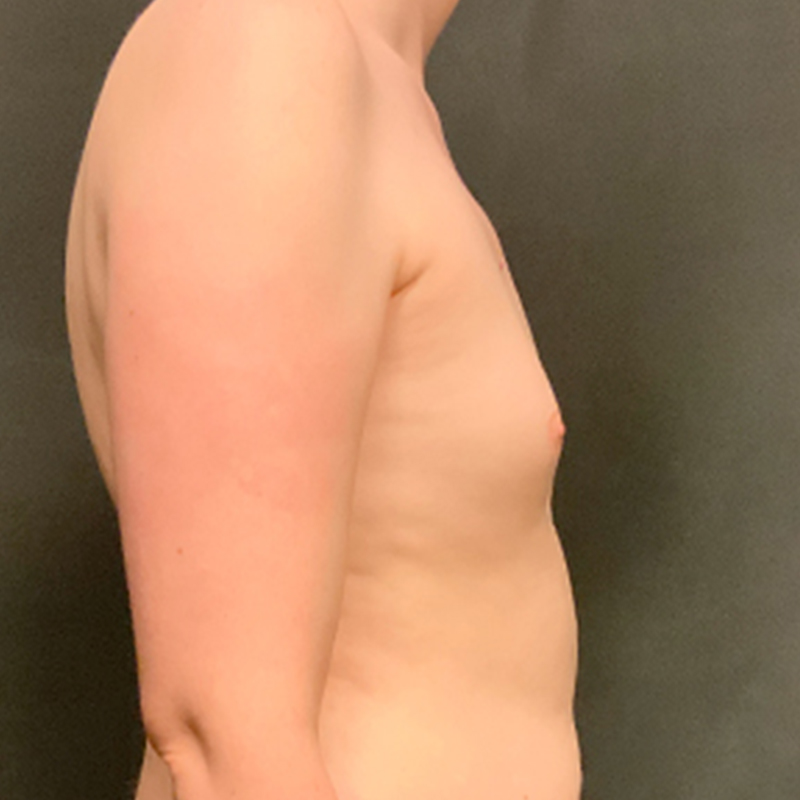 Mtf Breast Augmentation 07