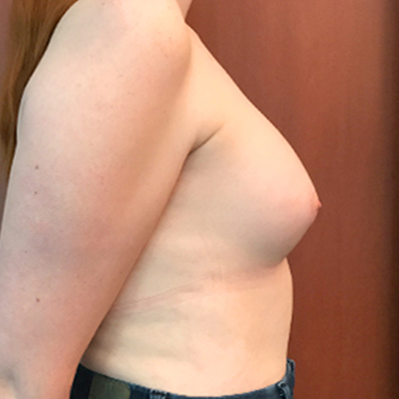 Mtf Breast Augmentation 07