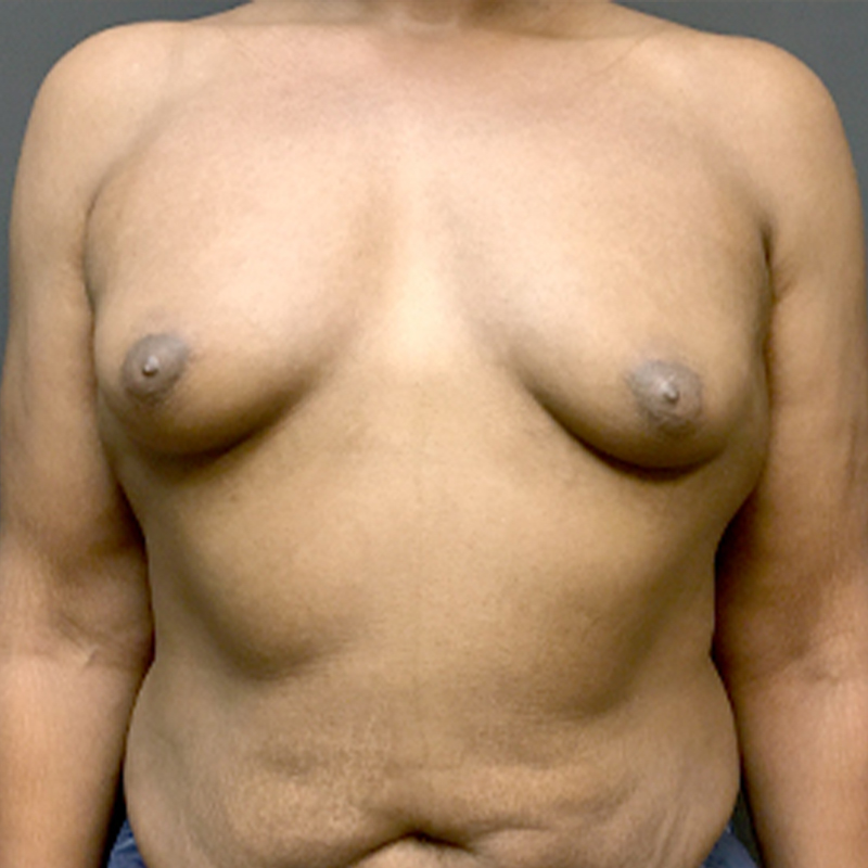 Mtf Breast Augmentation 01