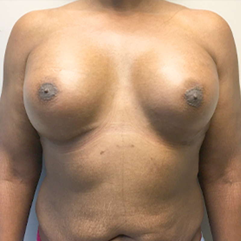Mtf Breast Augmentation 22