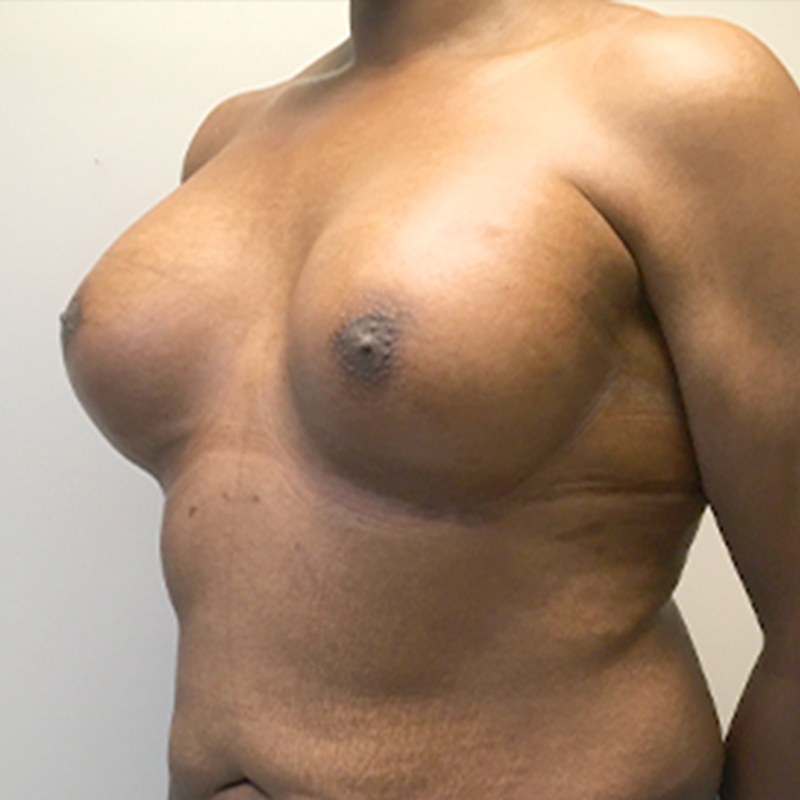 Mtf Breast Augmentation 03
