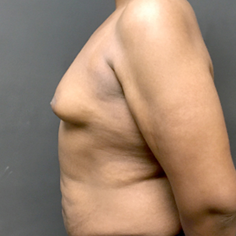 Mtf Breast Augmentation 05