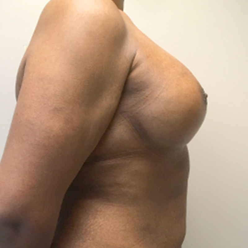 Mtf Breast Augmentation 09