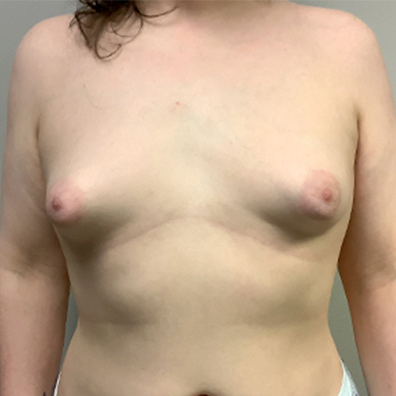 Mtf Breast Augmentation 01