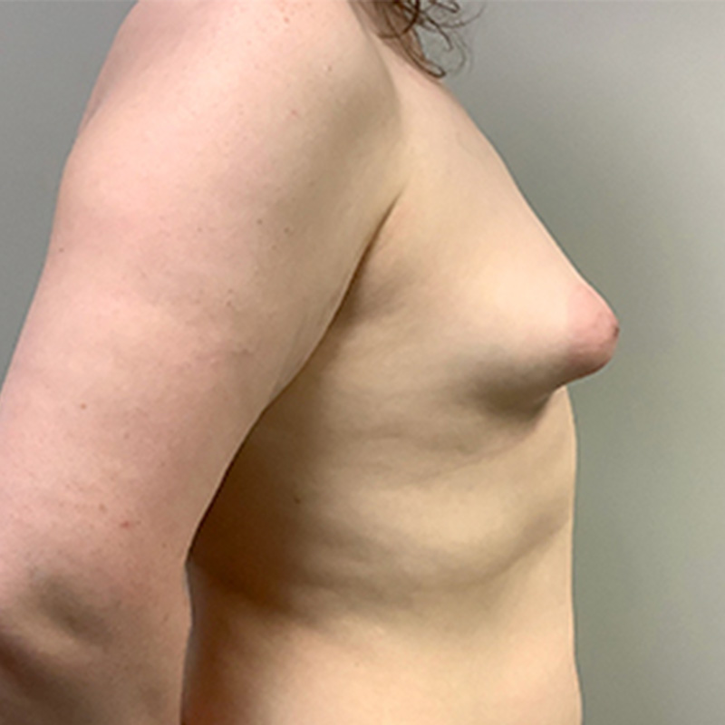 Mtf Breast Augmentation 05