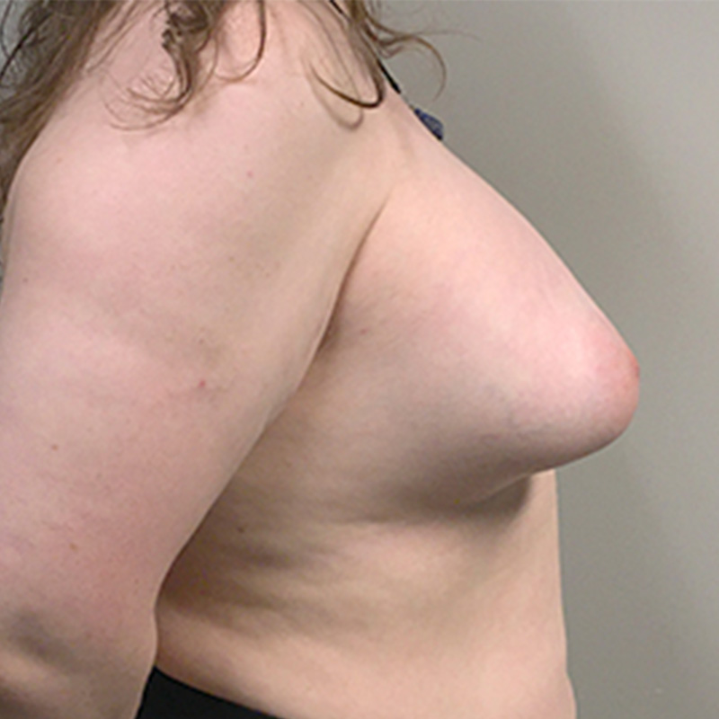 Mtf Breast Augmentation 05