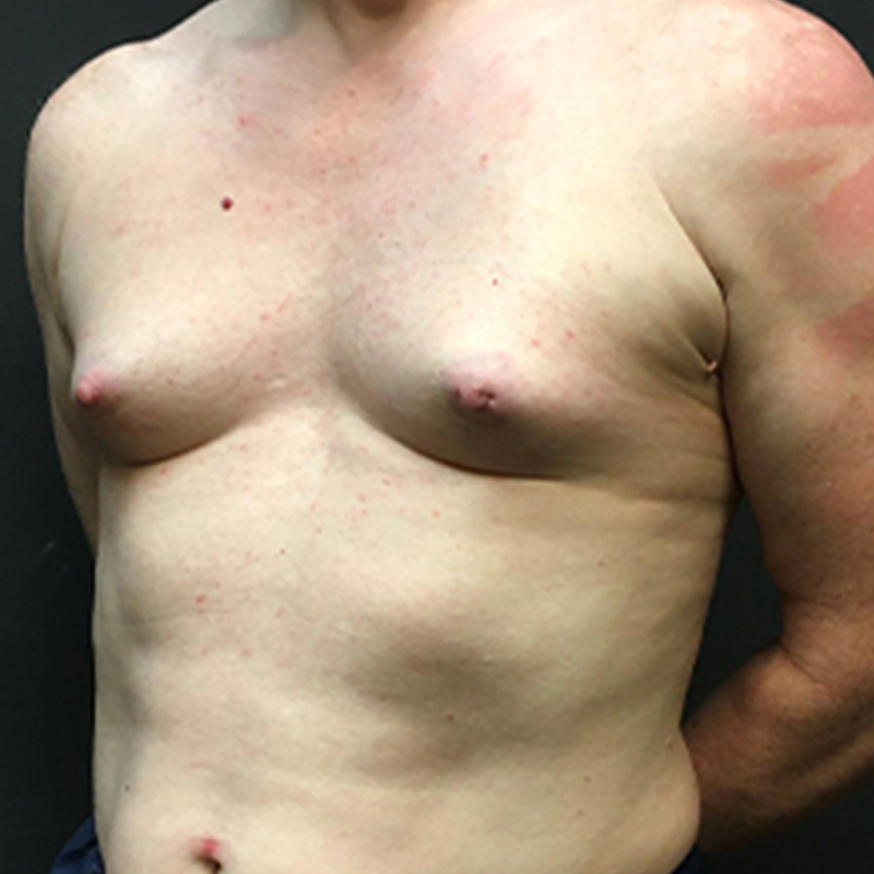 Mtf Breast Augmentation 01