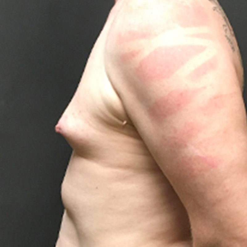 Mtf Breast Augmentation 05