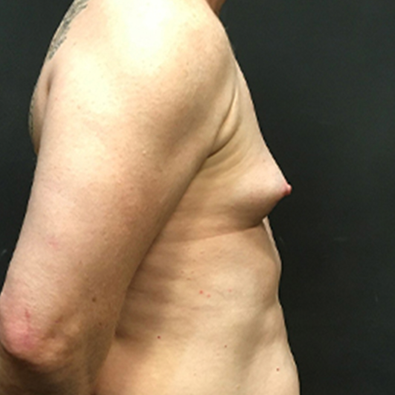 Mtf Breast Augmentation 09