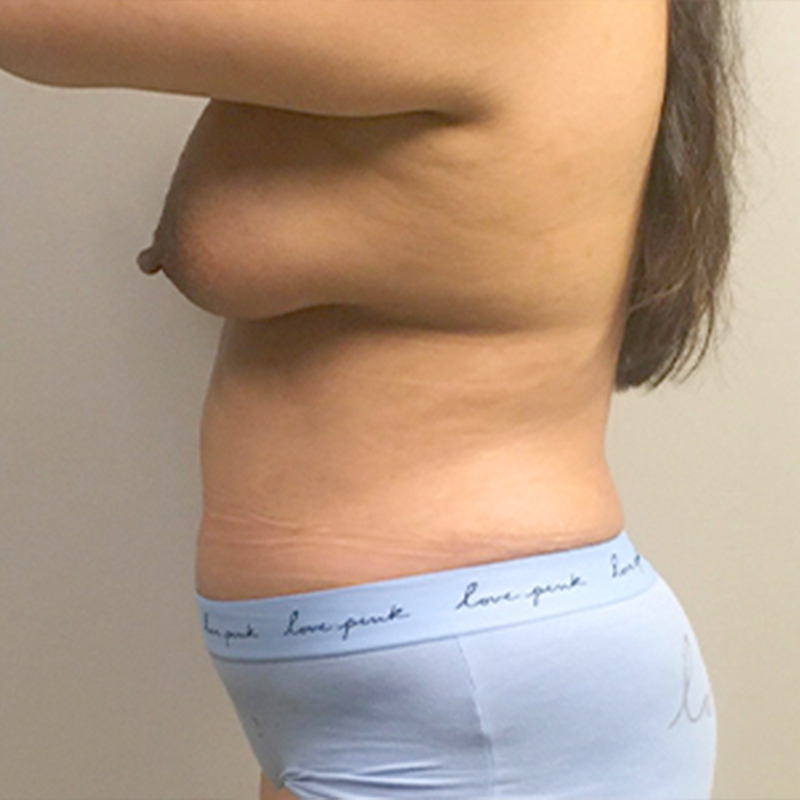 Mtf Breast Augmentation 05