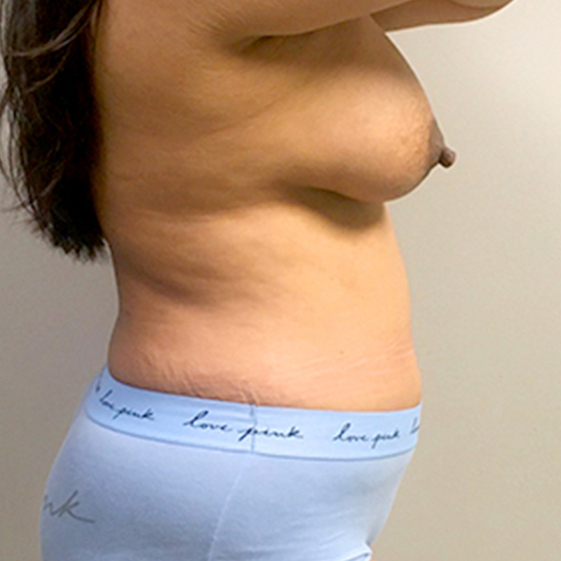 Mtf Breast Augmentation 09
