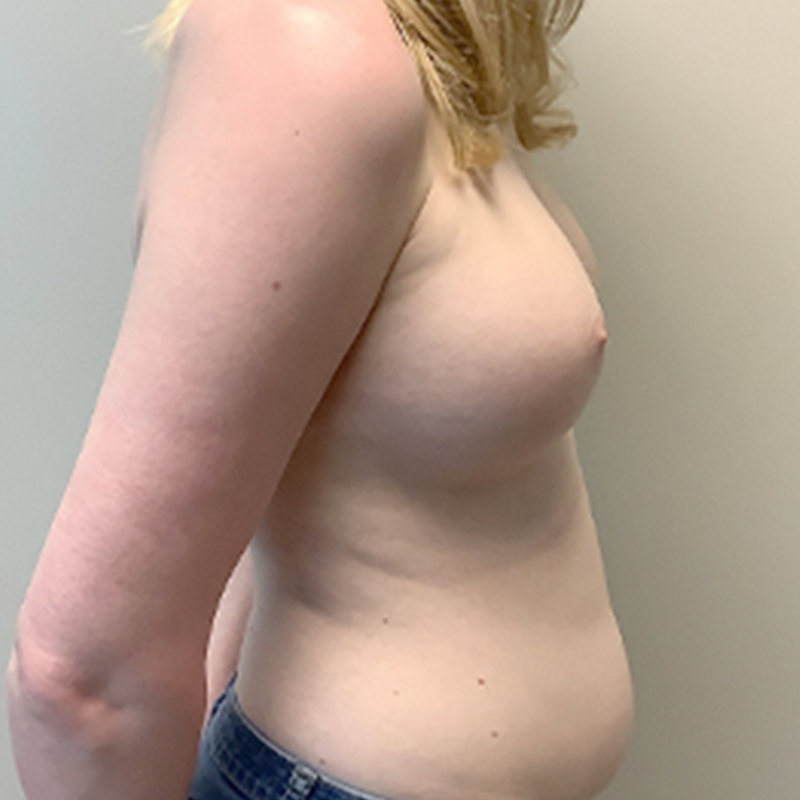 Mtf Breast Augmentation 05