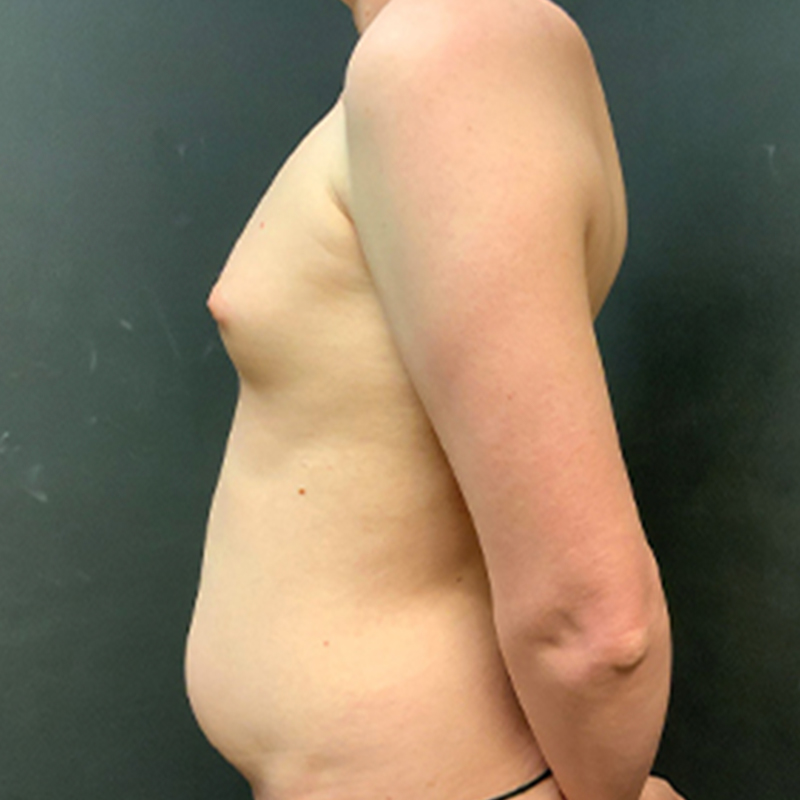 Mtf Breast Augmentation 09