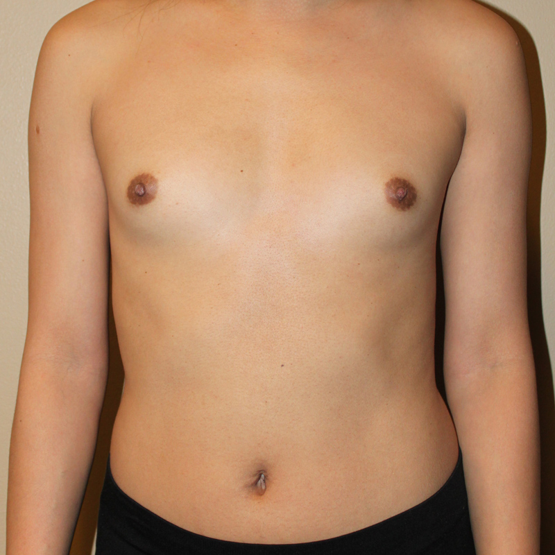 Mtf Breast Augmentation 01
