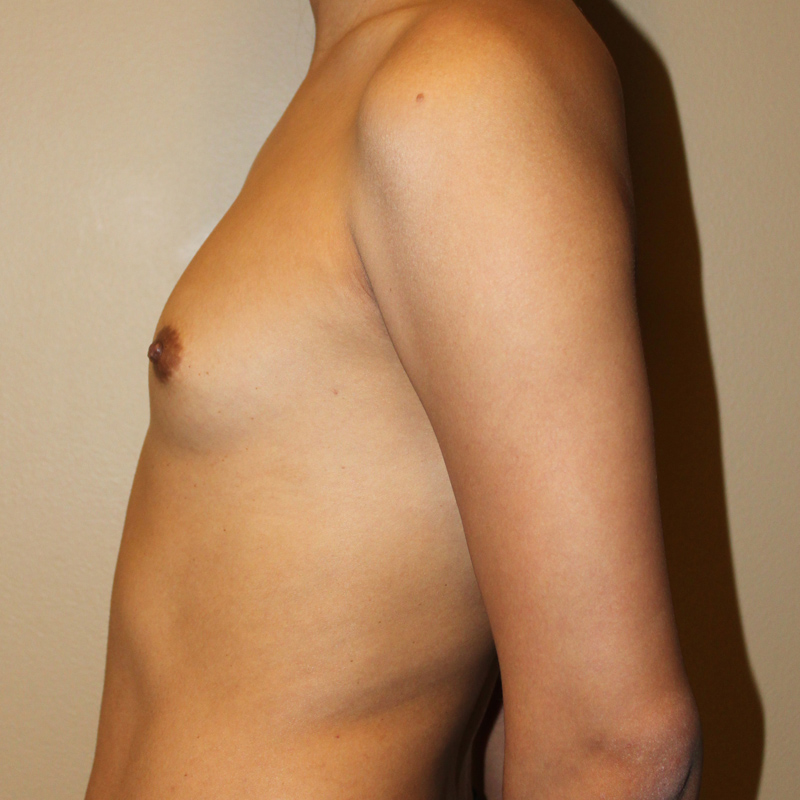 Mtf Breast Augmentation 05