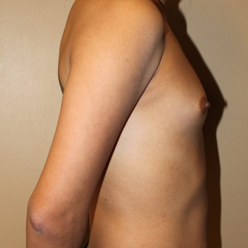 Mtf Breast Augmentation 07