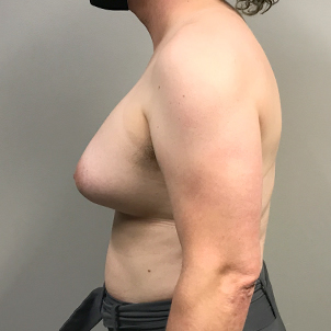 Mtf Breast Augmentation 05