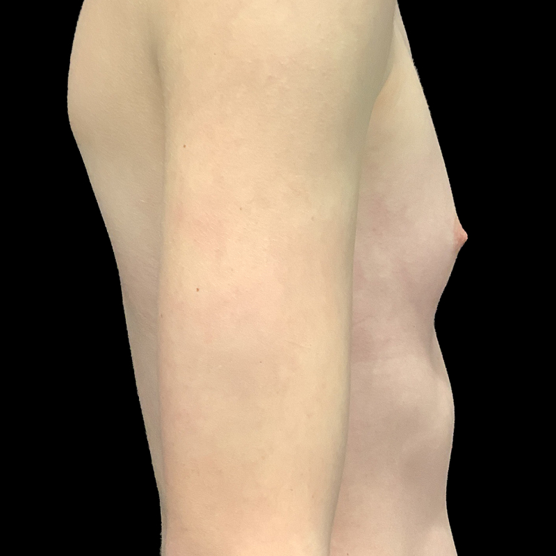 Mtf Breast Augmentation 03