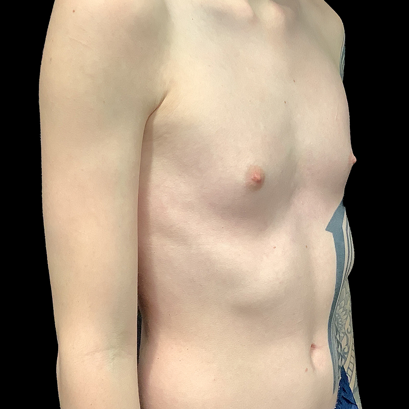 Mtf Breast Augmentation 05