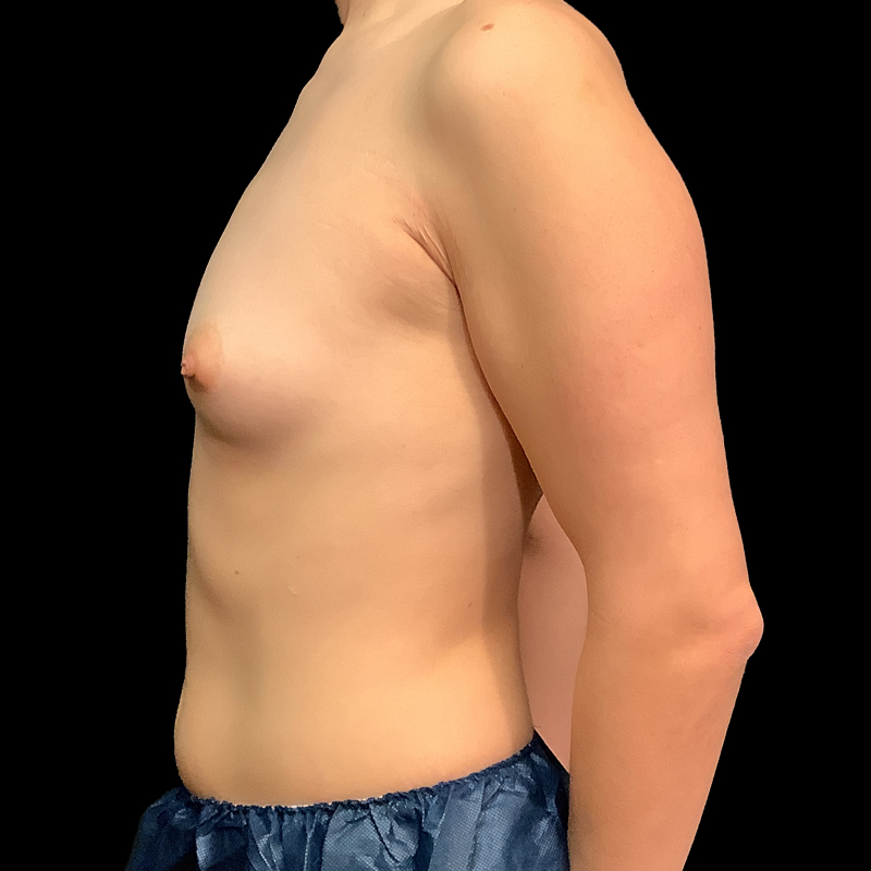 Mtf Breast Augmentation 03