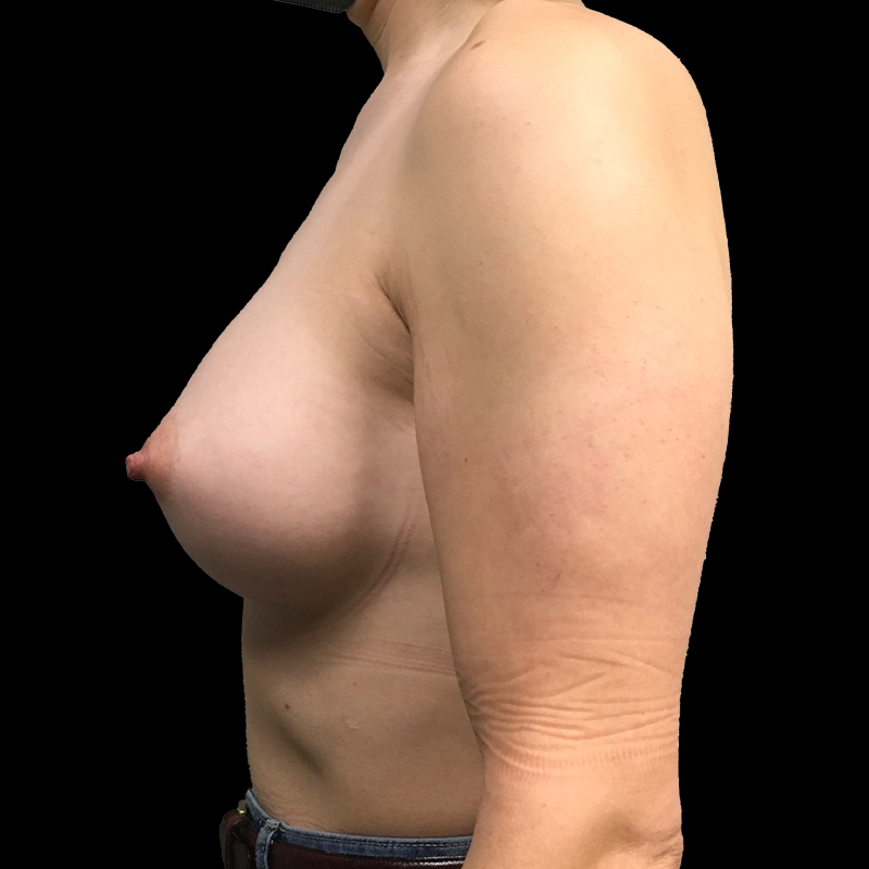Mtf Breast Augmentation 03
