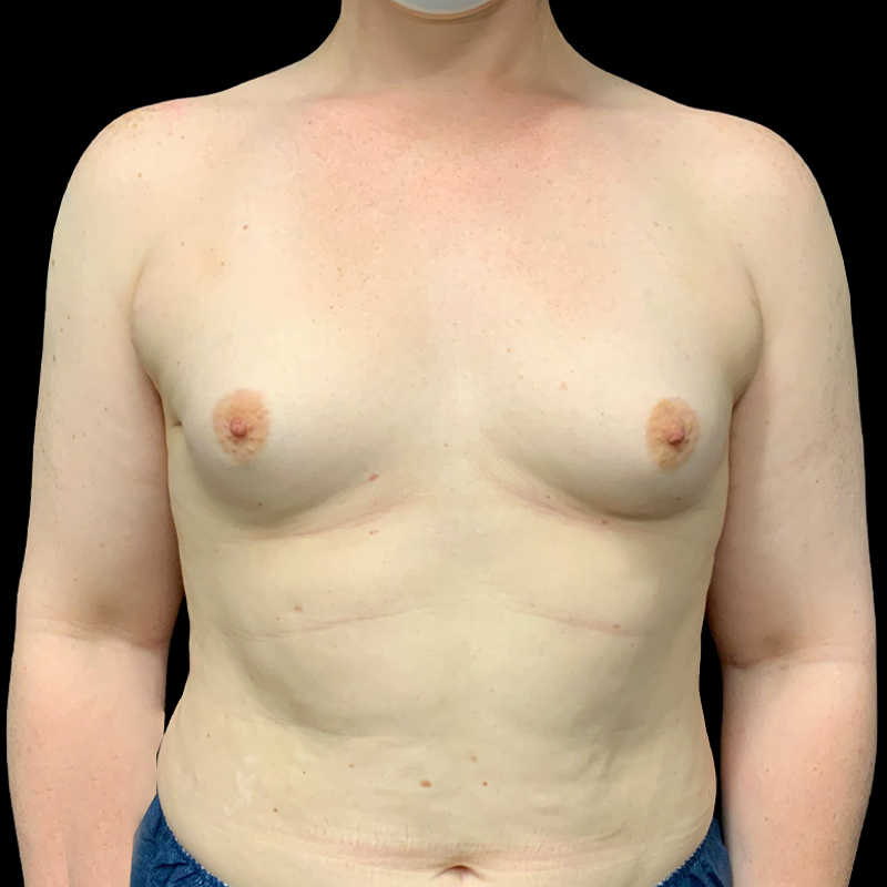 Mtf Breast Augmentation 01
