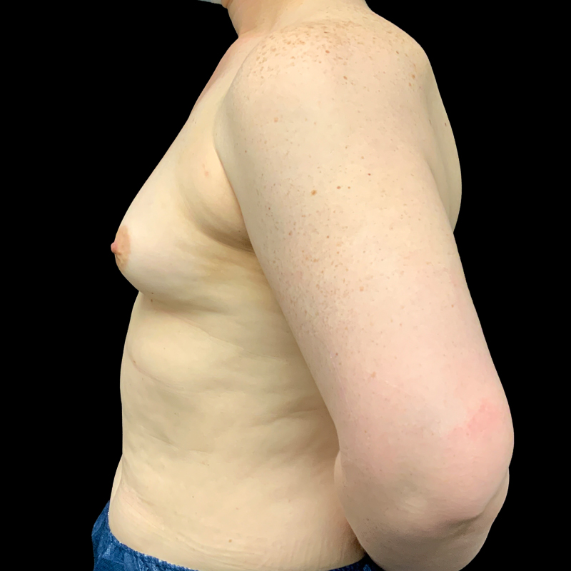 Mtf Breast Augmentation 05