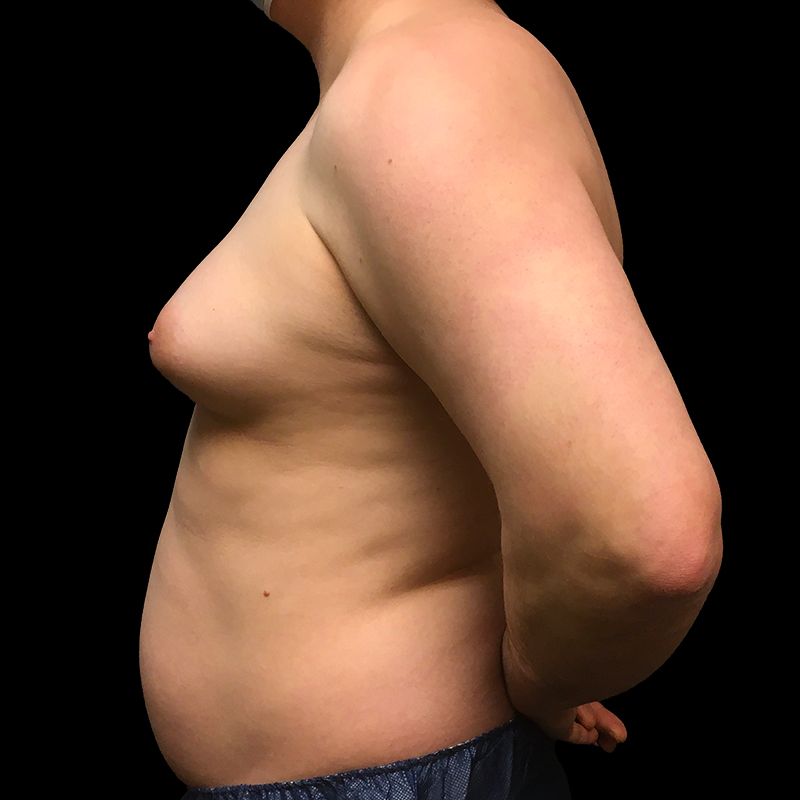 Mtf Breast Augmentation 05