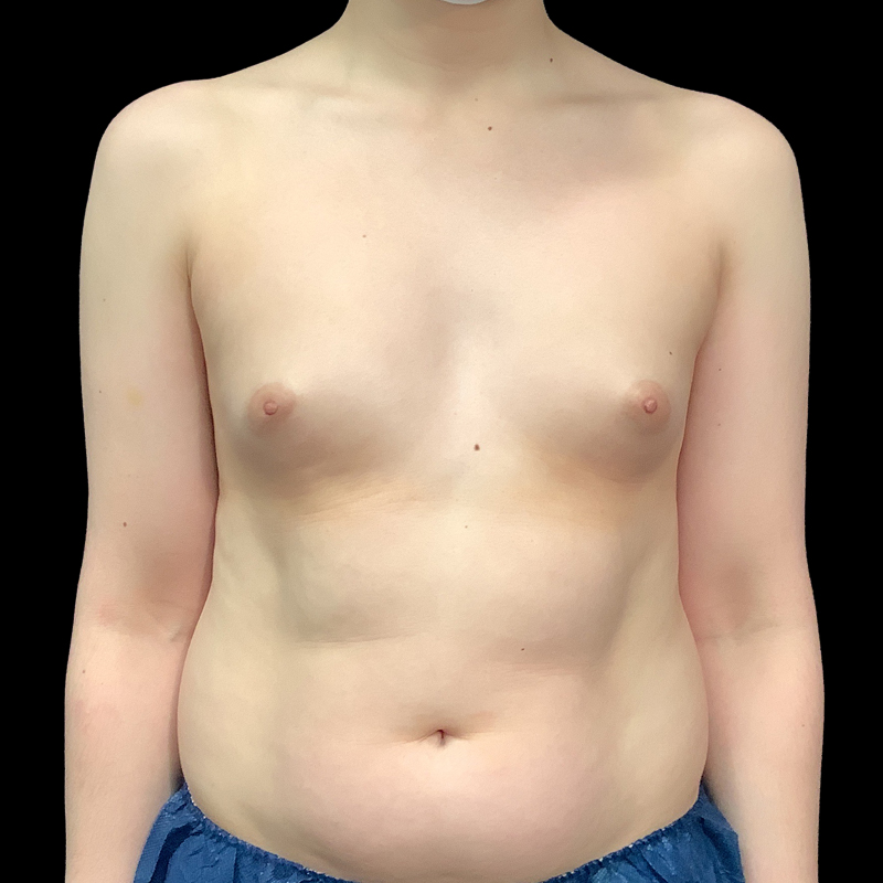 Mtf Breast Augmentation 01