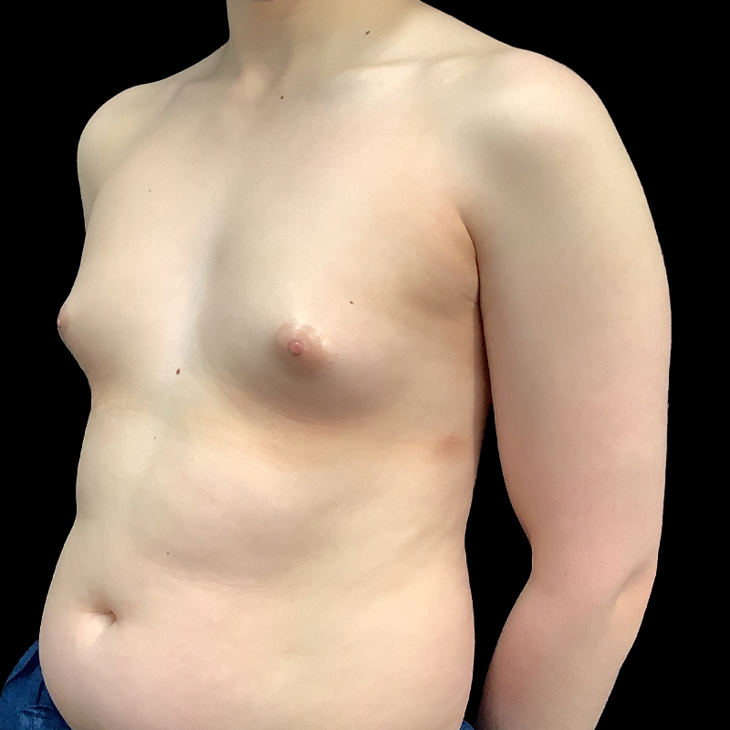 Mtf Breast Augmentation 03