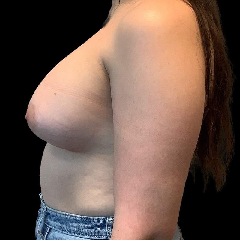 Mtf Breast Augmentation 05