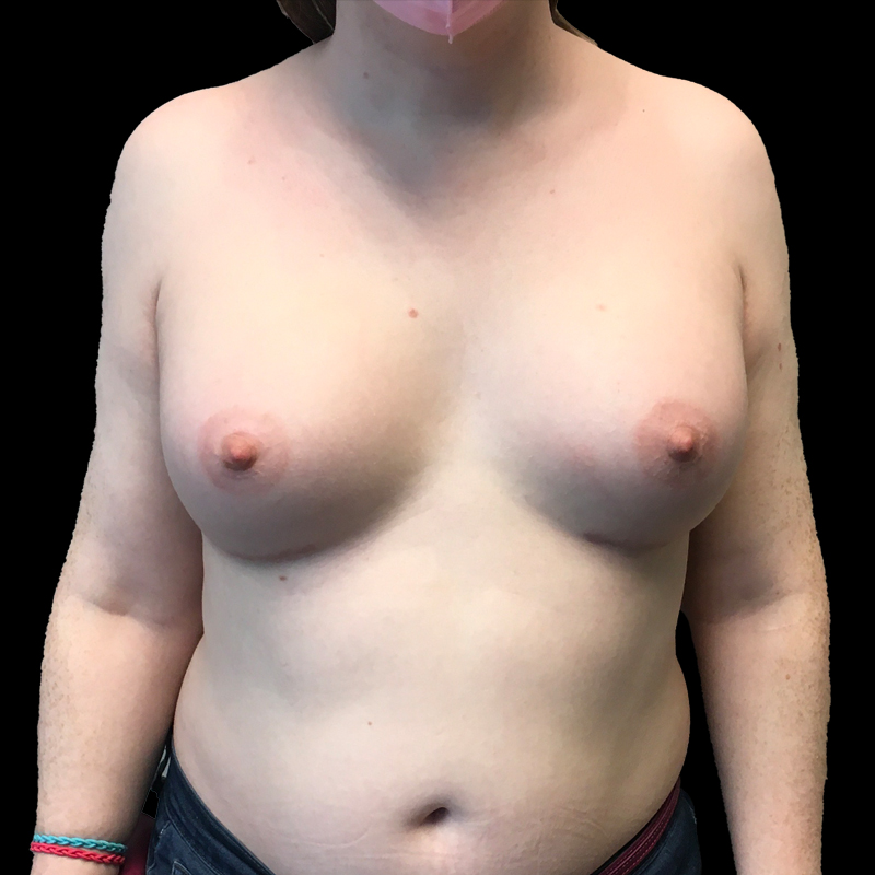 Mtf Breast Augmentation 35