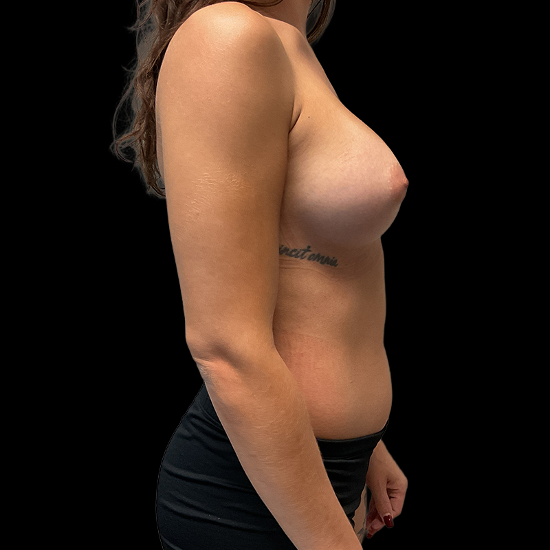 Mtf Breast Augmentation 05