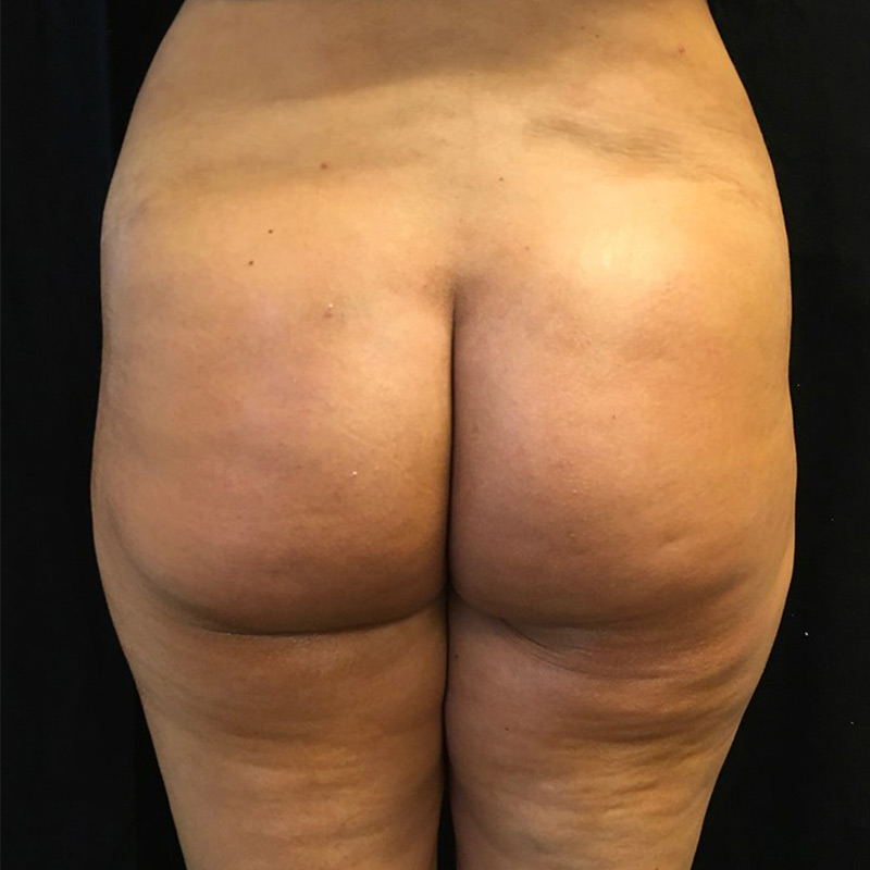 Non Surgical Brazilian Butt Lift 01