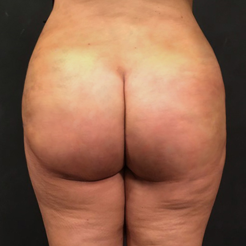 Non Surgical Brazilian Butt Lift 02
