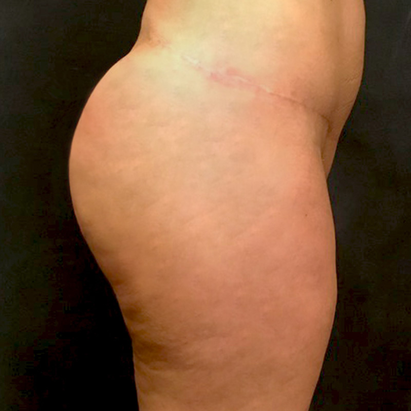 Non Surgical Brazilian Butt Lift 03