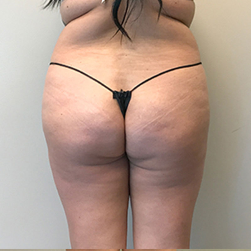 Non Surgical Brazilian Butt Lift 04
