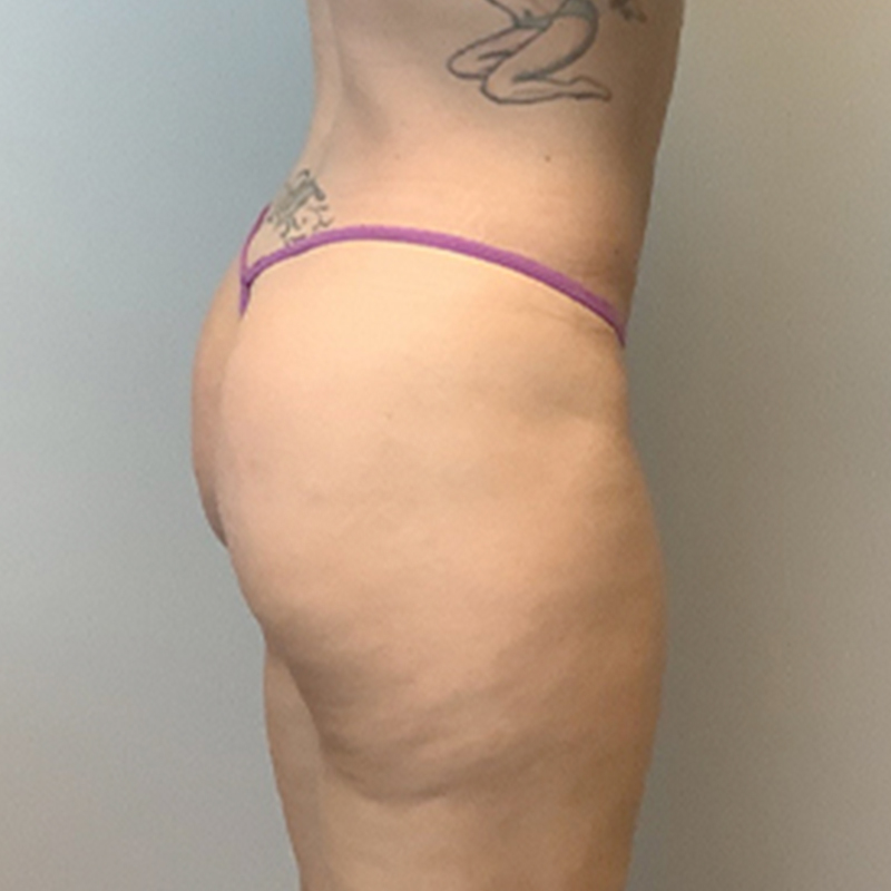 Non Surgical Brazilian Butt Lift 07