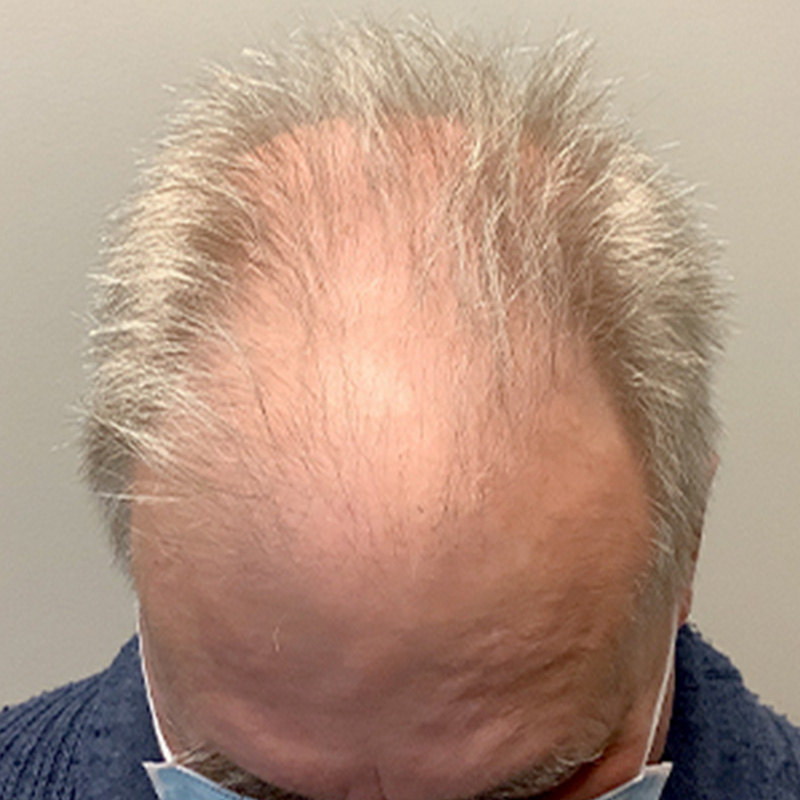 Non Surgical Hair Restoration 01