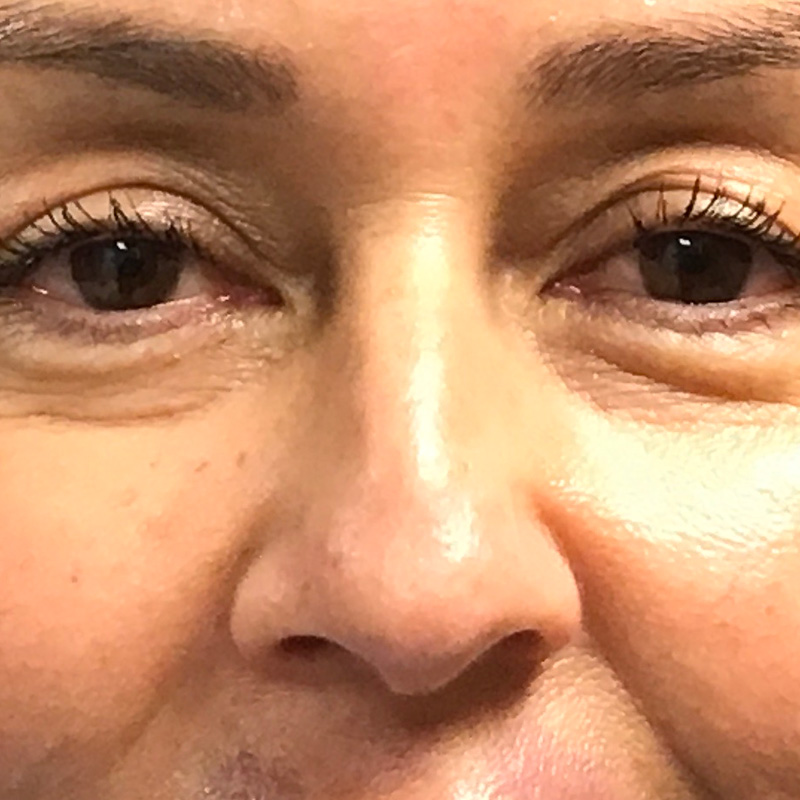 Non Surgical Rhinoplasty 01