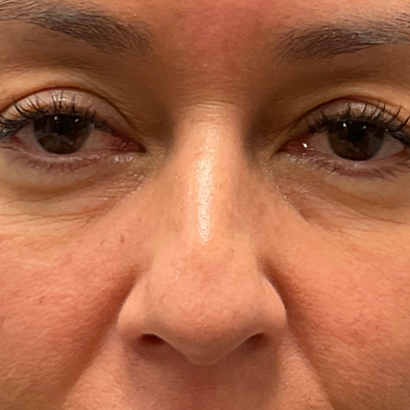 Non Surgical Rhinoplasty 01