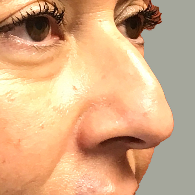 Non Surgical Rhinoplasty 05