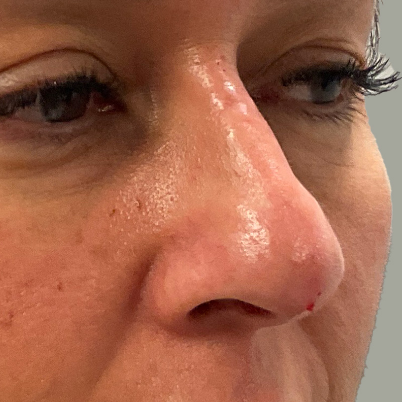 Non Surgical Rhinoplasty 05