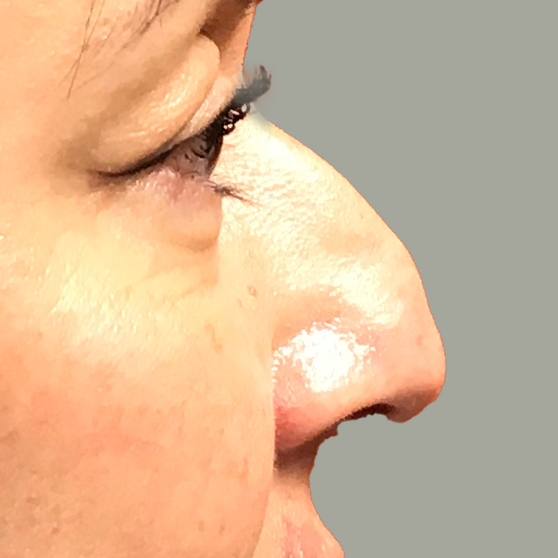 Non Surgical Rhinoplasty 07