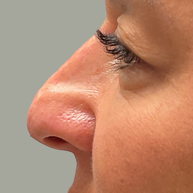 Non Surgical Rhinoplasty 09