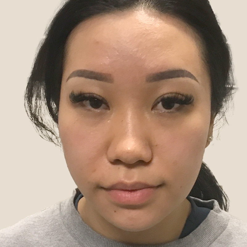 Non Surgical Rhinoplasty 01